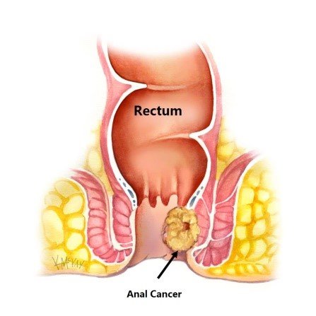 Fistula Ani Tidak Kunjung Sembuh: Apakah Kanker Anus?