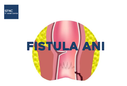 Fistula Ani, Penyebab Hingga Pengobatannya
