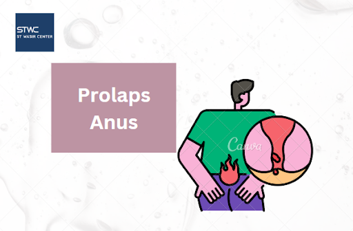 Prolaps anus: Penyebab, Gejala, dan Pengobatan