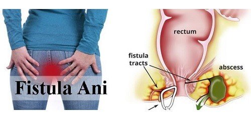 Mengenal Fistula Ani pada Wanita