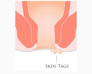 Apakah Berbahaya Skintag Timbul Setelah Operasi Wasir?