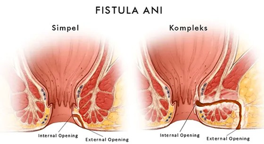 Penyebab Fistula Ani Lama Menutup