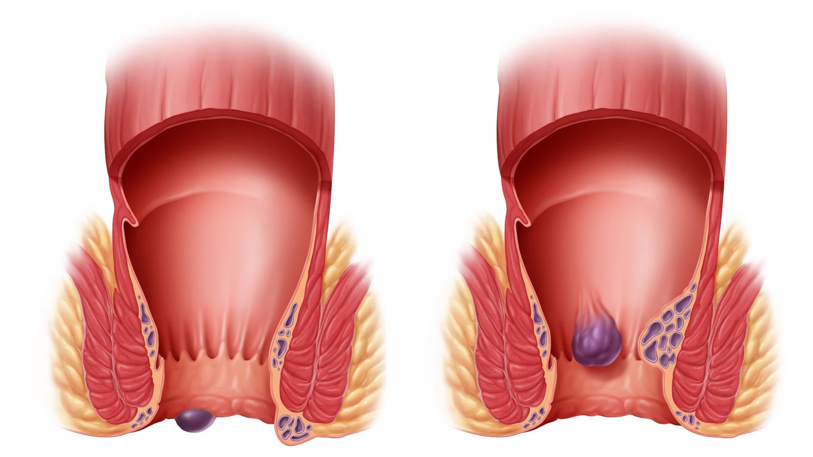 Solusi untuk Benjolan Wasir (Hemoroid)