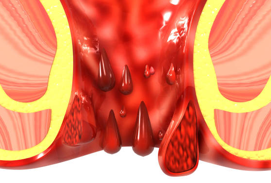 Obat untuk Wasir Berdarah