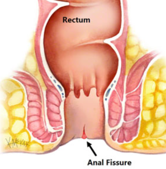 Apakah Operasi Fisura Ani Menyakitkan?