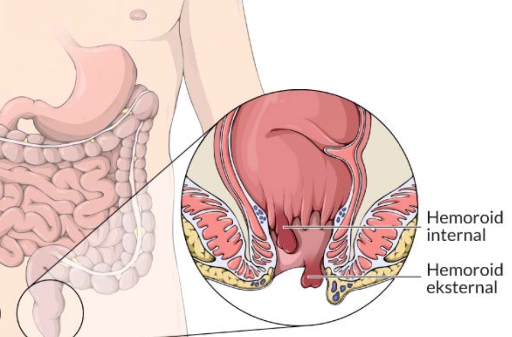 Wasir yang Berbahaya