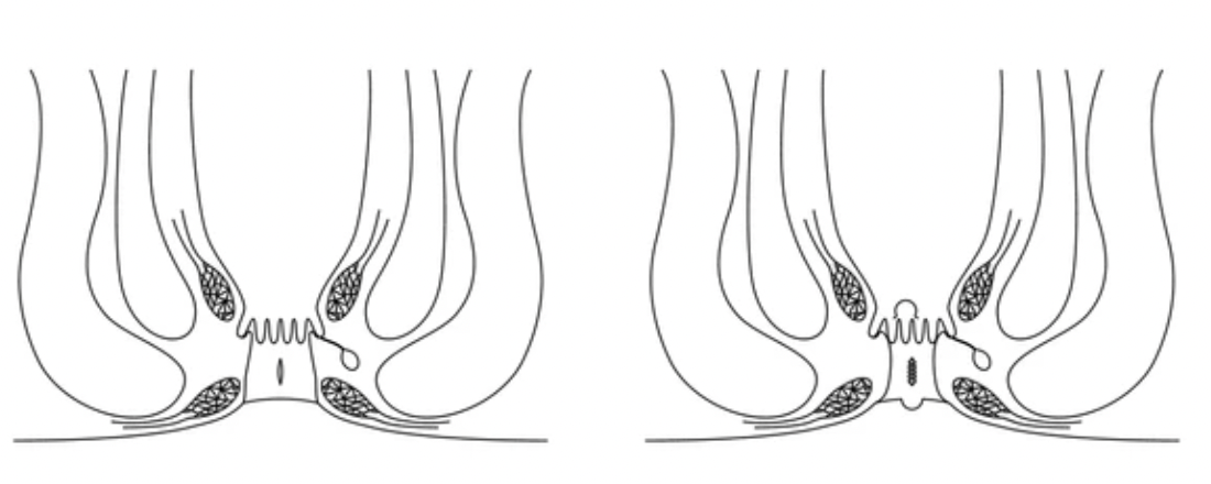 Apakah Seks Anal Menyebabkan Wasir?