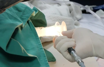 Fistula Ani Tuntas Cepat dengan Laser