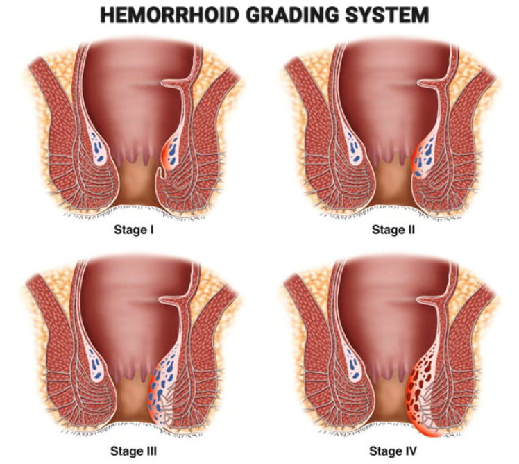 Wasir Grade 4 Sakit: Penyebab, Gejala, dan Solusi Pengobatan