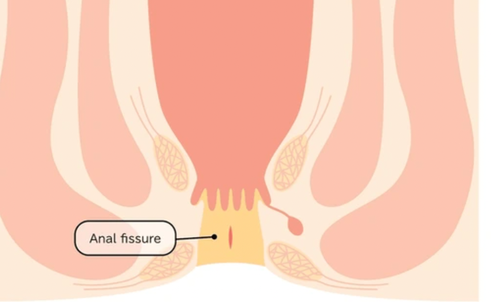 Cara Menghilangkan Fisura Anus Selamanya