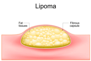 Solusi lipoma tanpa operasi