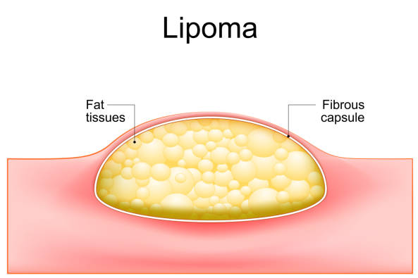 Solusi Lipoma Tanpa Operasi