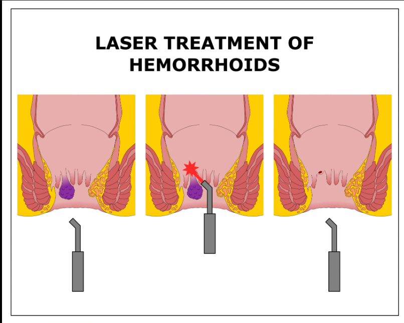 Kekurangan Operasi Ambeien Laser