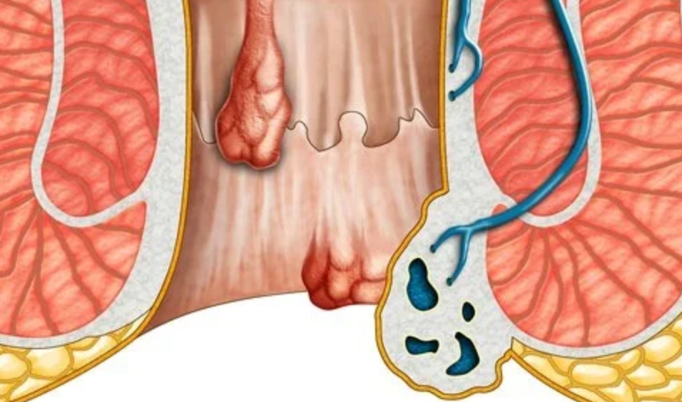 Operasi Abses Anus: Solusi Mengatasi Infeksi Serius